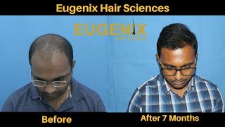 Hair Transplant Clinic in Bhubaneswar Odisha  Hair Transplant Surgeon  Eugenix [upl. by Imef]