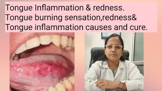 Tongue Inflammation amp rednessTongue burning sensationrednessamp Tongue inflammation causes and cure [upl. by Ahasuerus]