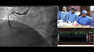 Multivessel precision PCI in a patient with 21 years of postPCI clinical follow [upl. by Macintosh]