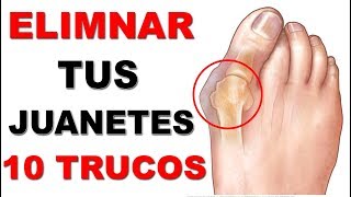 10 Trucos Infalibles Para Eliminar Los Juanetes QUITA los juanetes sin cirugía [upl. by Ramgad]