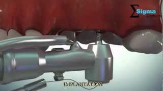 Implant bridge Dental Implants Animated video [upl. by Azer334]