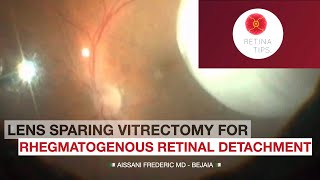 Lens sparing vitrectomy for rhegmatogenous retinal detachment [upl. by Cardinal72]