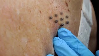 Extreme Blackhead Removal by Hand 2024 [upl. by Hcir904]