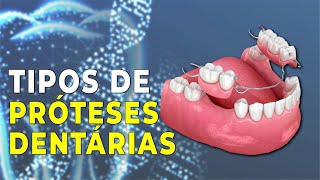 TIPOS DE PRÓTESES DENTARIAS [upl. by Winston]