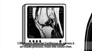 Larthrose est une maladie qui se soigne [upl. by Arica661]