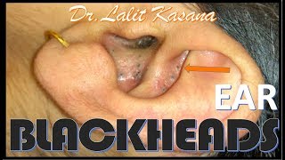 EAR COMEDONES by DrLalit Kasana [upl. by Veal]