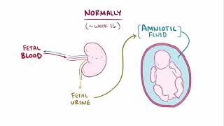 Renal agenesis [upl. by Yevad]