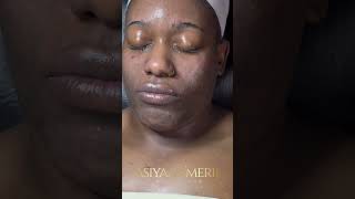 Microneediling esthetician atlanta acne hyperpigmentation [upl. by Aikym711]