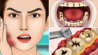 ASMR Molar Tooth Caries Removal so Satisfying part3  Dental Care Animation  어금니 우식증 제거 너무 만족 [upl. by Arot]