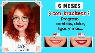 6 MESES CON BRACKETS 😁 PROGRESO DOLOR TIPS  MI EXPERIENCIA Mirem Itziar ❤ [upl. by Chema]