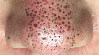 Acne treatment pimples popping blackhead removal on the nose 032 [upl. by Eeleak849]