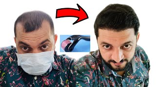 How to use Derma roller and Minoxidil at home  hair transplant results [upl. by Shah]