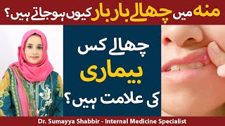 Moun Main Chalon Ka Ilaj  Munh Mein Chhale Kyon Hote Hain  Mouth Ulcer Treatment In Urdu [upl. by Hungarian]