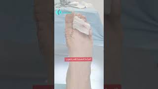 Chirurgie du pied جراحة القدم لتقويم اعوجاج الابهامrabat meknes marrakech tanger [upl. by Marlette]