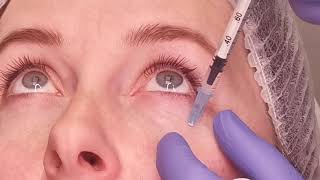 Way of work with Dermaheal Eye Bag Solution Caregen [upl. by Bj]