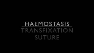 Haemostasis  Transfixation suture [upl. by Krenn]