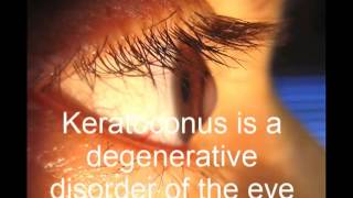 Keratoconus [upl. by Ethyl]