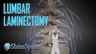 Lumbar Laminectomy [upl. by Einra]