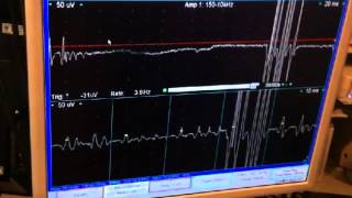 Electromyographic Recording of Peripheral Nerve Hyperexcitability [upl. by Edrick]