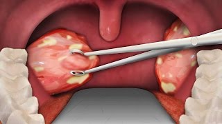 TONSIL REMOVAL SURGERY  Tonsillectomy Surgery [upl. by Arabella]