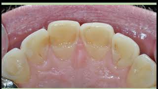 NECADE Session 34  Dentin Bonding [upl. by Jessika105]