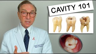 What Causes Tooth Decay Cavity 101  Causes  Treatment [upl. by Acie]