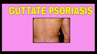 Guttate Psoriasis  Symptoms  Treatments  Causes  Pictures  Type [upl. by Yerocaj]