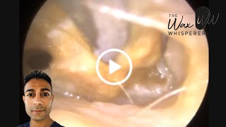 973  Ear Wax Removal in Severely Infected Ears [upl. by Notgnirrab]