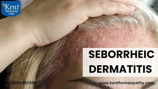 Seborrheic dermatitis सेबोरिक डर्मटाइटिस [upl. by Ynaffyt621]