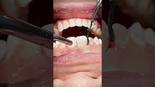 Class V tooth caries composite restoration dentisry [upl. by Daniele]