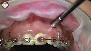 Miniscrew removal in orthodontics [upl. by Latsyrc944]