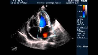 Pericarditis AgudaTaponamiento Cardiaco Dr Pedro Guillermo Bustos 12 Julio 2011 [upl. by Leinadnhoj]