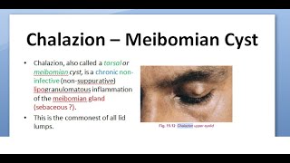 Ophthalmology 376 Chalazion Meibomian Cyst triamcinolone DIATHERMY tetracycline MALIGNANCY Eyelid [upl. by Anoval277]