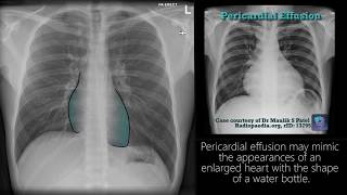 Radiograph Tutorial Chest Xray  CXR  Radiology Nation [upl. by Bluhm]