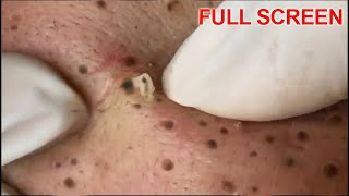 Blackheads Removal  Best Pimple Popping Videos [upl. by Kcin]