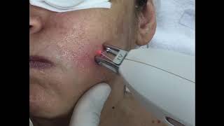 Besenreiser Couperose und Rosacea entfernen mit NdYagLaser [upl. by Theall]