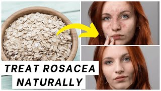 DIY Rosacea Treatments Natural Remedies That Actually Work  Skincare Tips [upl. by Hamer]