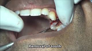 Grossly decayed upper premolar extraction [upl. by Suiratnauq]