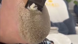 Pedicure video33，scales on the heel，vertical plantaris，plantar wart [upl. by Gorrono68]