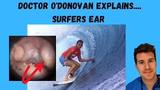 Explaining Surfers Ear aka Exostosis  With Dr ODonovan [upl. by Suisyola597]