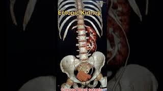 ectopic kidney ct scan medicalimaging shortvideo [upl. by Enaillil]