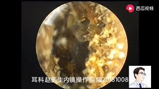 Ear wax removal Bilateral external auditory canal cholesteatoma 8 minutes 双侧外耳道胆脂瘤，8分钟 [upl. by Akieluz79]