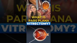 What is Pars Plana Vitrectomy [upl. by Oivaf]