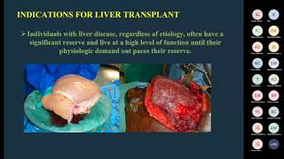 2022 ABSITE Review Transplant [upl. by Whitford]