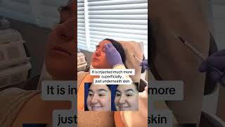 Eyebrow lift with Microbotox  Beautiful Girls [upl. by Auqinu]