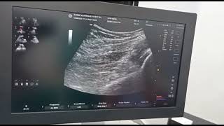 Ultrasound guided Hip Joint Injection [upl. by Riesman]