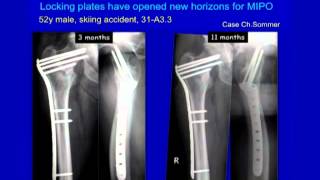 Complex Proximal Femur Fractures [upl. by Niuqram]