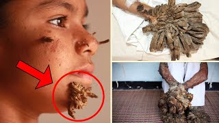 The MOST BIZARRE Skin Disorder Unveiling The Mystery Of TreeMan Syndrome Incredible facts [upl. by Schnur156]