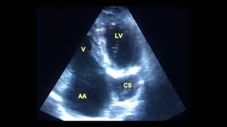 Coronary sinus mimicking a cyst to drahmadmirdamadisikTUfcNTCW7N2iR8 [upl. by Dulcine]