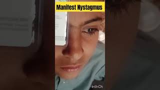 manifest Nystagmus  nystagmus eyediseases [upl. by Latsyrhc399]